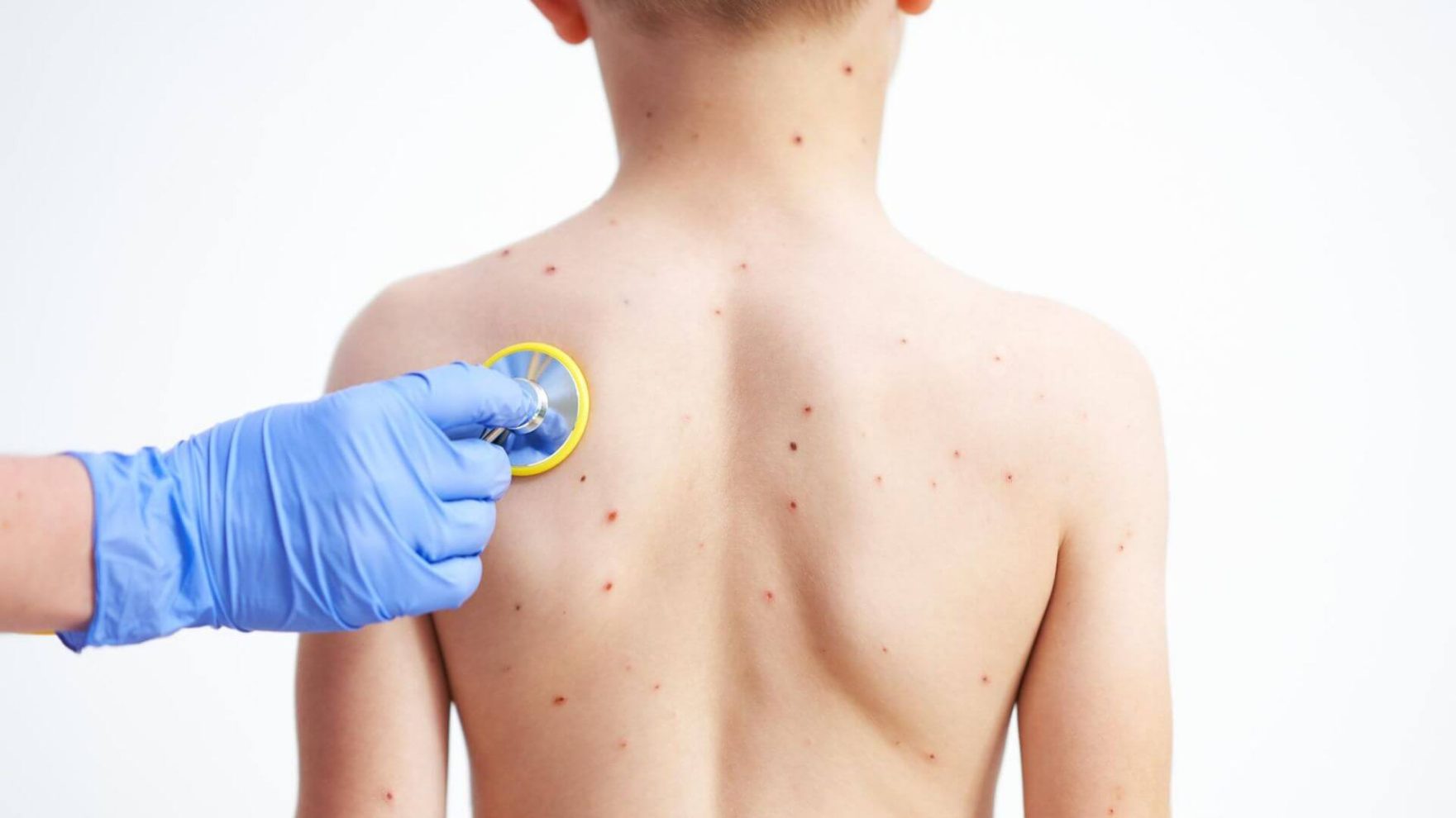 O que você realmente sabe sobre catapora?