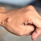 neurofibromatose