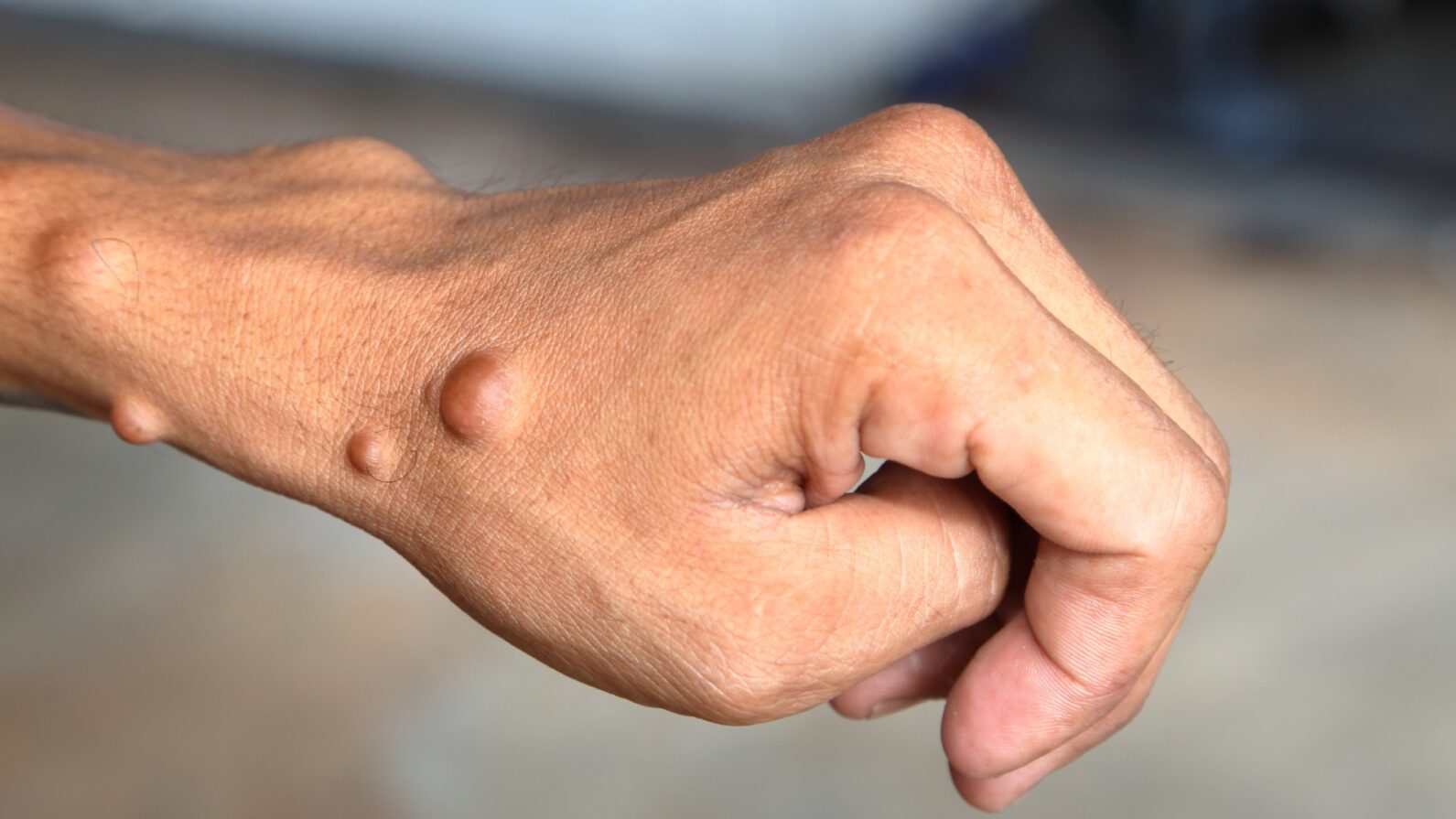 neurofibromatose