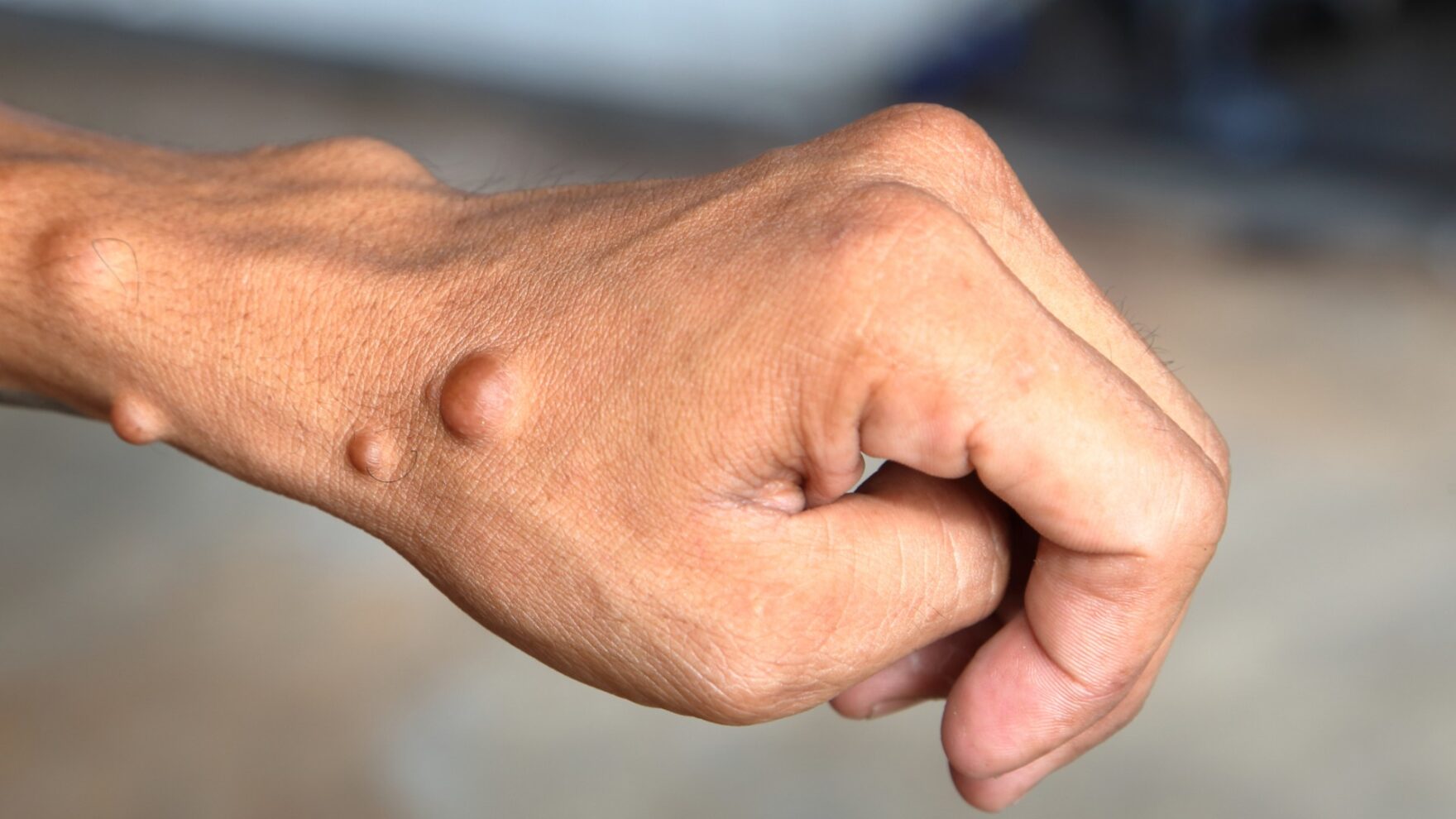 Neurofibromatose: entenda o que causa essa doença genética