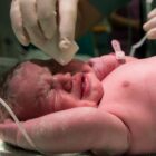 Síndrome de Turner no Teste Genético da Bochechinha